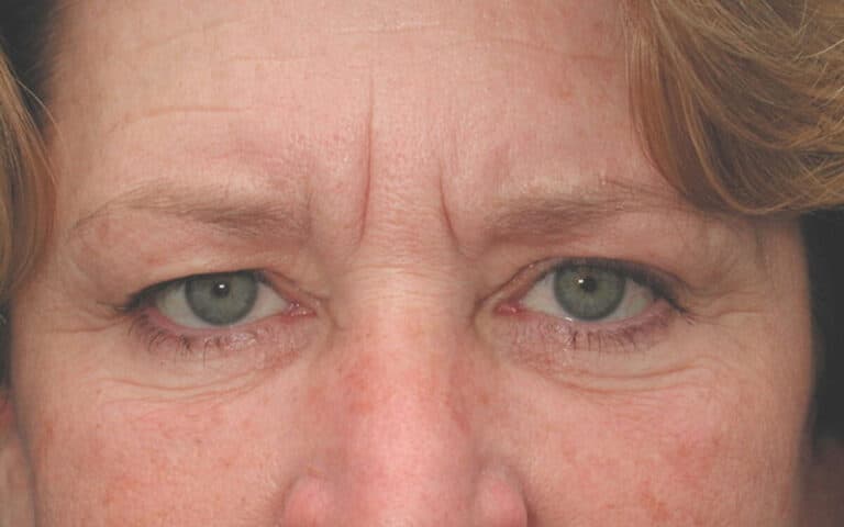 Before Image: Brow Lift - front