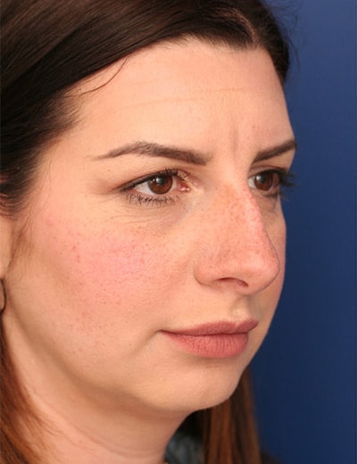 Before Image: Rhinoplasty - front