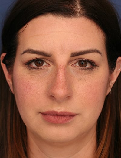 Before Image: Rhinoplasty - front