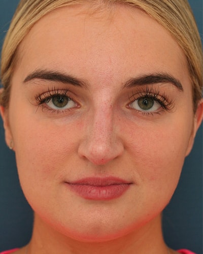After Image: Non-surgical – Nose -