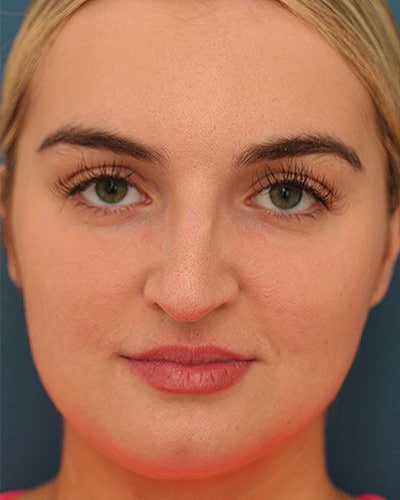 Before Image: Non-surgical – Nose -