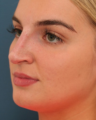 After Image: Non-surgical – Nose - left-front-oblique