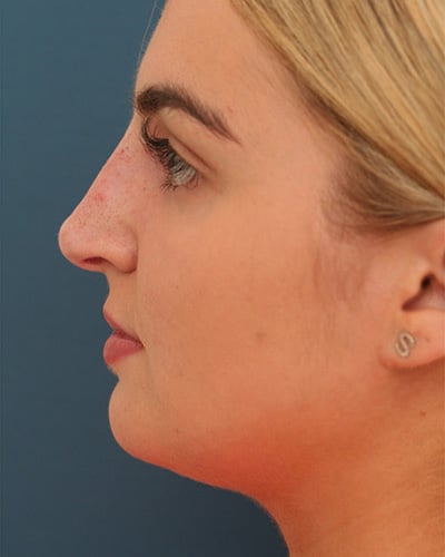 After Image: Non-surgical – Nose - left-side