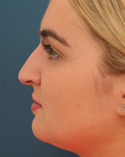 Before Image: Non-surgical – Nose - left-side