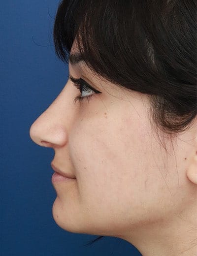 After Image: Rhinoplasty - left-side