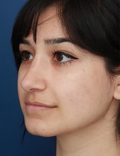 After Image: Rhinoplasty - left-front-oblique