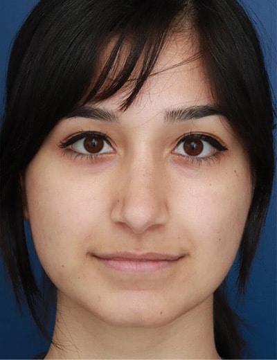 After Image: Rhinoplasty - front