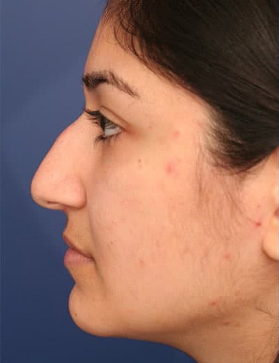Before Image: Rhinoplasty - left-side