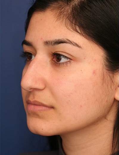 Before Image: Rhinoplasty - left-front-oblique