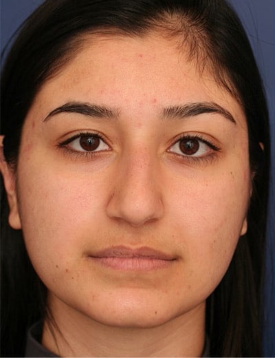 Before Image: Rhinoplasty - front
