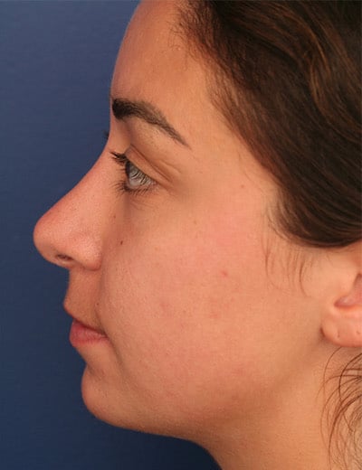After Image: Rhinoplasty - left-side