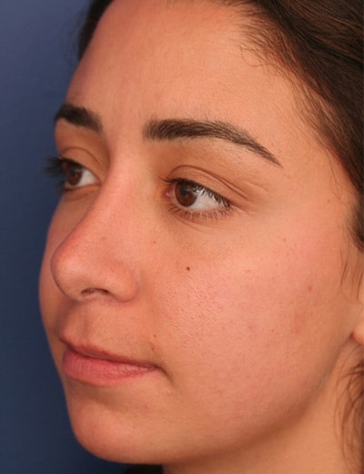 After Image: Rhinoplasty - left-front-oblique