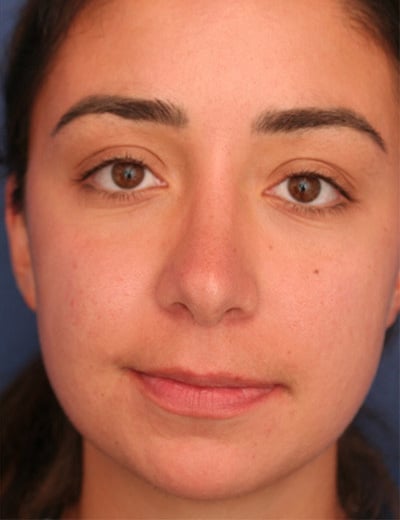 After Image: Rhinoplasty - front
