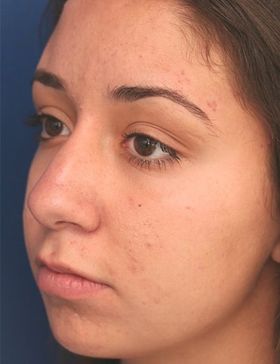 Before Image: Rhinoplasty - left-front-oblique