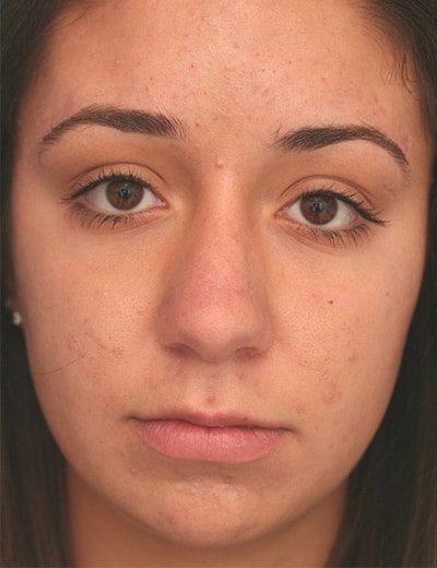 Before Image: Rhinoplasty - front
