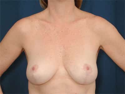 After Image: Breast Lift - front