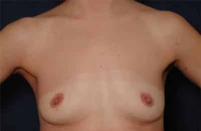 Before Image: Breast Augmentation - front