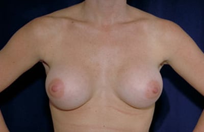 After Image: Breast Augmentation - front