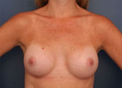 After Image: Breast Augmentation - front