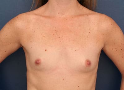 Before Image: Breast Augmentation - front