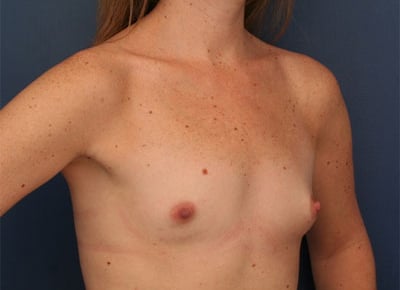 Before Image: Breast Augmentation - right-front-oblique