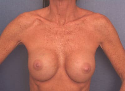 After Image: Breast Augmentation - front