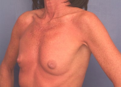 Before Image: Breast Augmentation - left-front-oblique