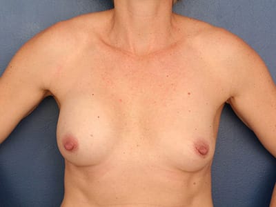 Before Image: Breast Augmentation - front