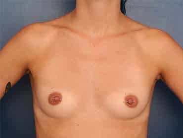 Before Image: Breast Augmentation - front