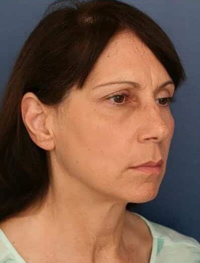 Before Image: Facelift - right-front-oblique