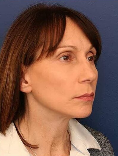 After Image: Facelift - right-front-oblique
