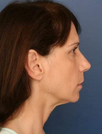 Before Image: Facelift - right-side