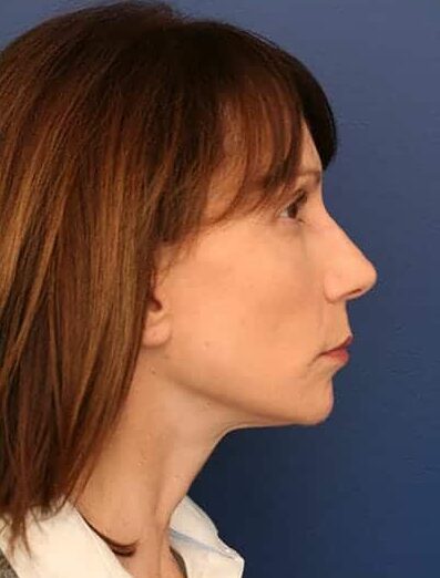 After Image: Facelift - right-side