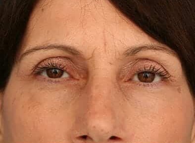 Before Image: Facelift - front