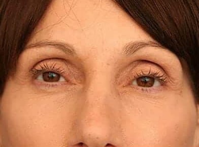 After Image: Facelift - front