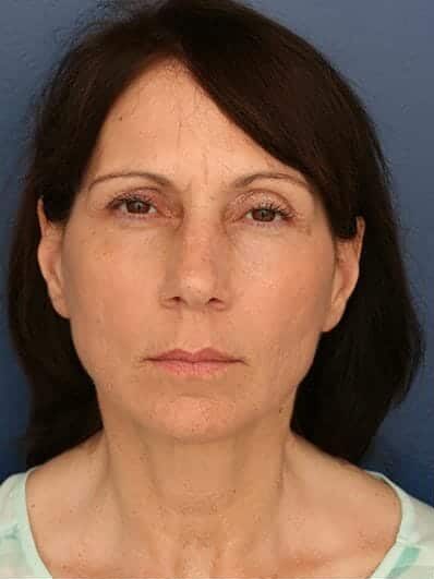 Before Image: Facelift - front