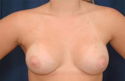 After Image: Breast Augmentation -