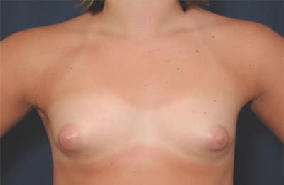 Before Image: Breast Augmentation -