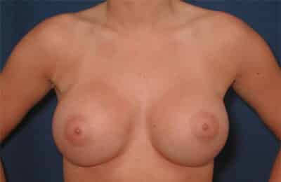 After Image: Breast Augmentation - front