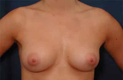 Before Image: Breast Augmentation - front