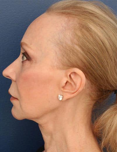 After Image: Chin Surgery - left-side
