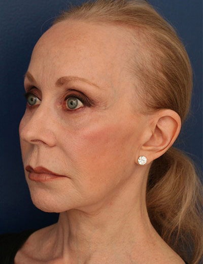 After Image: Chin Surgery - left-front-oblique