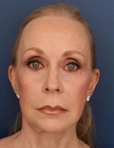 After Image: Chin Surgery - front