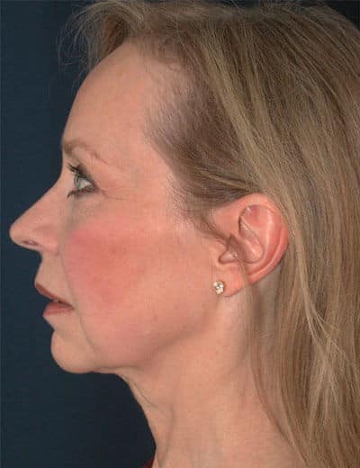 Before Image: Chin Surgery - left-side