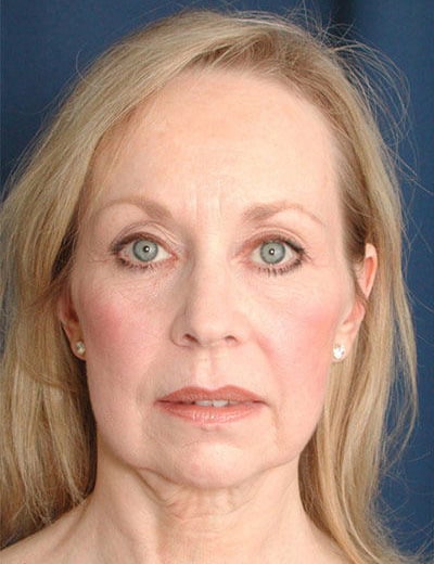 Before Image: Chin Surgery - front