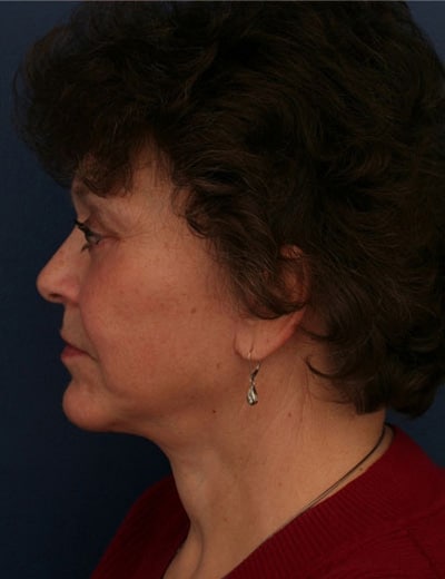 After Image: Chin Surgery - left-side