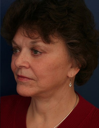 After Image: Chin Surgery - left-front-oblique