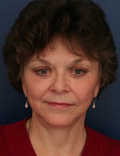 After Image: Chin Surgery - front