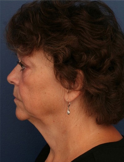 Before Image: Chin Surgery - left-side