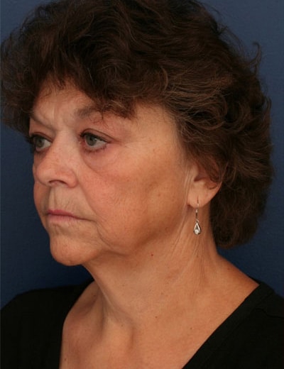 Before Image: Chin Surgery - left-front-oblique